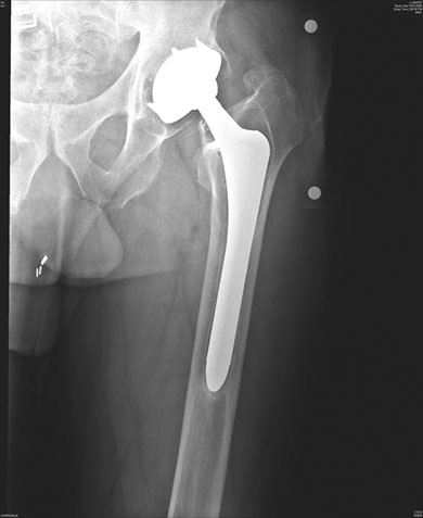 Preoperative roentgenogram 7 years after placement of a fully coated cementless stem. Note subsidence, bead shedding, radiolucent lines, lack of spot welds, and early pedestal formation