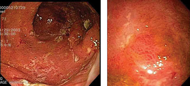 Pouchitis, endoscopically, is characterized by granularity, friability, and ulceration of the ileal pouch