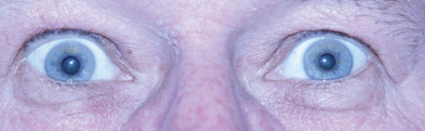 Diagnosis of Horner syndrome with apraclonidine drops (same patient as in Figure 23-1). The anisocoria is reversed with the right pupil being now slightly larger than the left pupil. The palpebral fissures are now symmetric