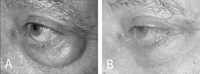 (A) A patient with prominent globes before lower eyelid blepharoplasty. (B) To avoid retraction, fixation of the SOOF and a lateral tarsal strip procedure were performed in addition to a standard transcutaneous blepharoplasty