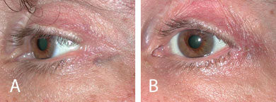 Lateral canthal blunting following blepharoplasty before (A) and after (B) reparative lateral canthoplasty