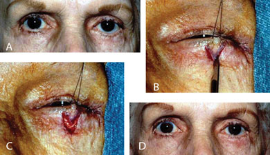 Contour abnormality due to focal scarring of the left lower eyelid (A). The area of scarring is released with a “V-shaped” incision (B). The eyelid is then able to be elevated to a normal position and the incision sutured in a “Y” configuration (C). The eyelid is in a more natural position (D) following the “V-Y” advancement flap