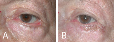 (A) Ectropion following lower eyelid blepharoplasty. (B) Improved eyelid position 