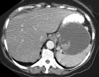 Cystic neoplasm in the tail of the pancreas. Laparoscopic approach for distal pancreatectomy not difficult in expert hands