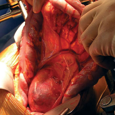 Pancreatic tail cyst as seen through the mesentery