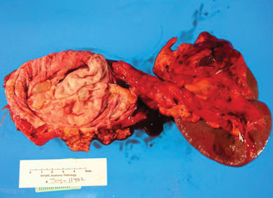 Specimen of resection leading to splenectomy due to infiltration of the splenic vein by the cystic mass