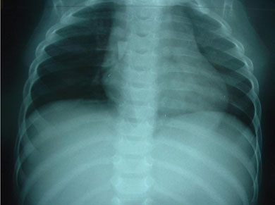 Chest radiograph from a 14-month-old girl with a 3-week history of cough