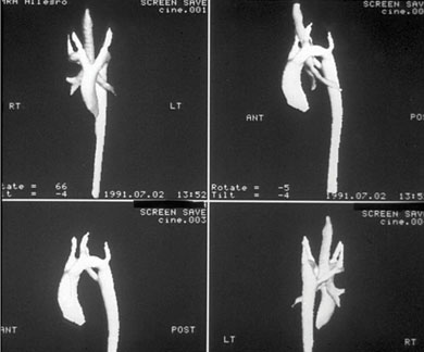 Contrast-enhanced chest CT image revealing a double aortic arch