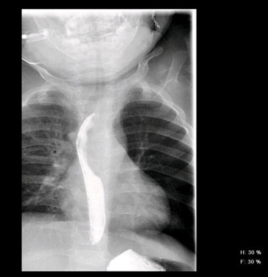 Barium esophagram image obtained in a 12-month-old boy evaluated for chronic wheezing