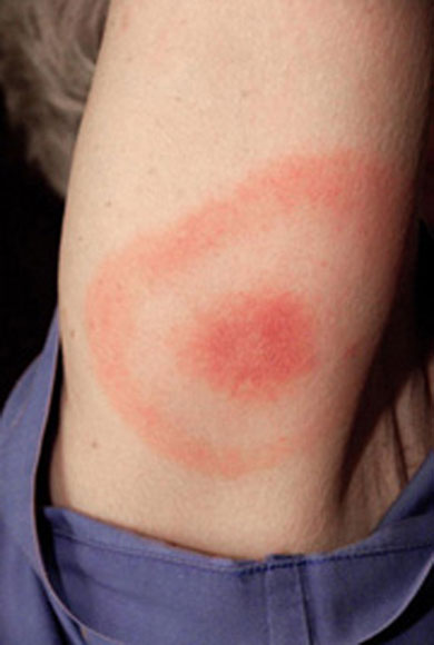 Erythema migrans rash