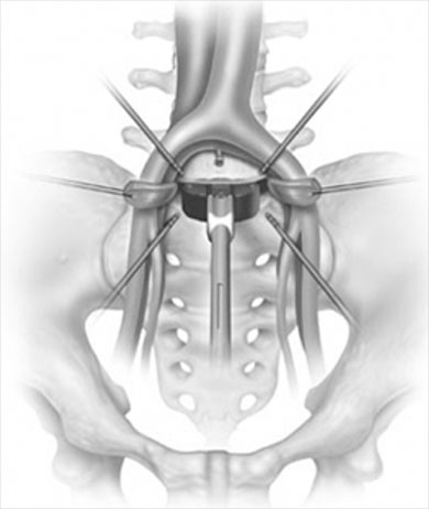 A schematic demostrating retraction of the external iliac vein with insertion of an ALIF cage