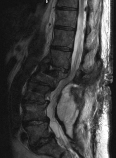 MRI study of deep wound infection. T2 weighted image shows collection of fluid deep in the fascia during the acute postoperative period