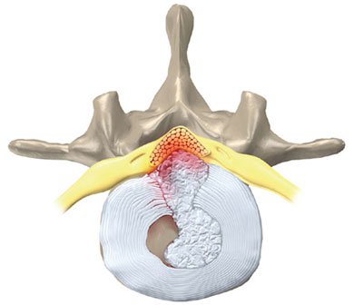 Schematic of a large, central lumbar disc herniation causing severe compression of the cauda equina