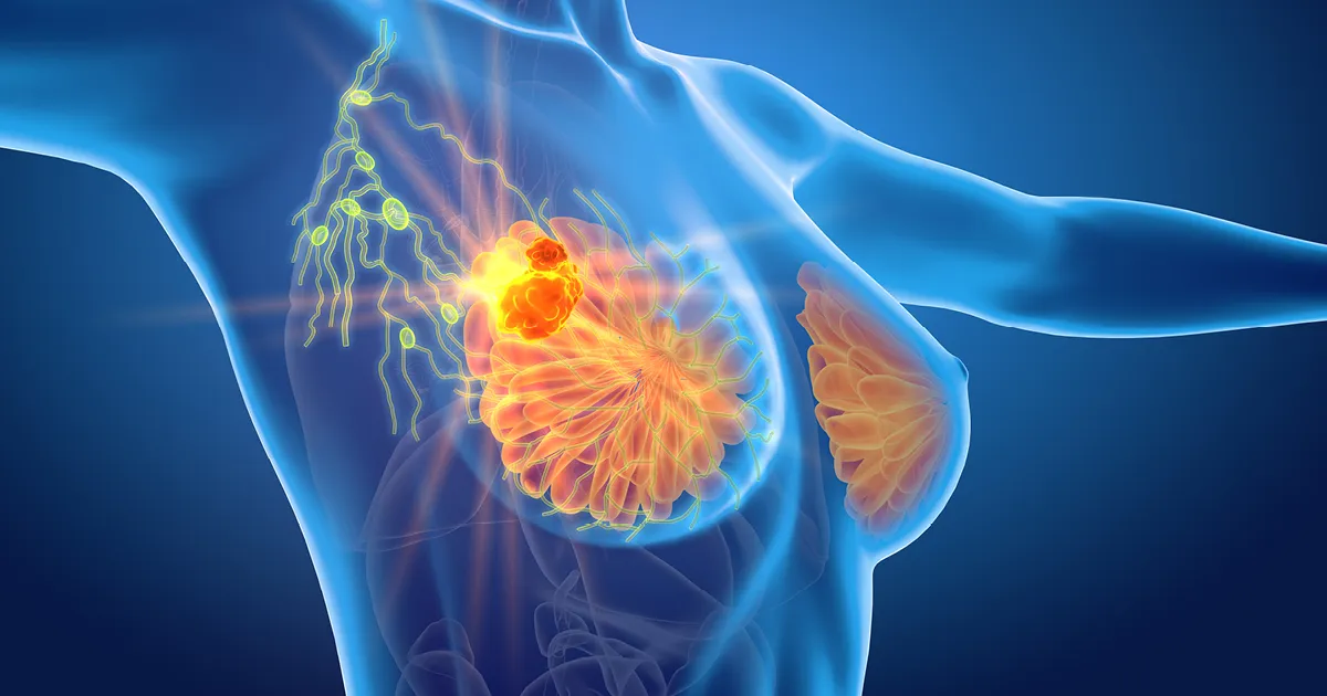 HER2-Positive Breast Cancer