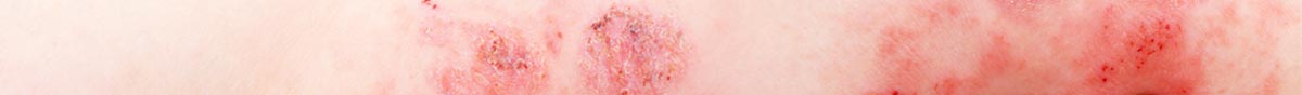 Take Homes in Atopic Dermatitis collection banner