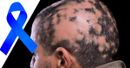 VIDEO: Treatment options for alopecia areata