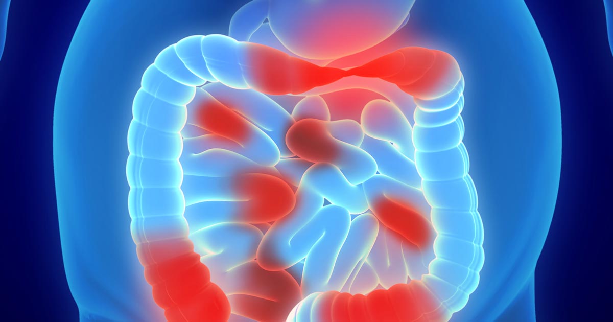 Image of inflammatory bowel disease