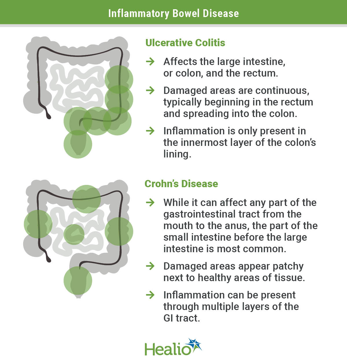 an infographic detailing the differences of ulcerative colitis and Crohn's disease. A the top is a green bar with white text centered in the middle that reads "Irritable Bowel Disease". Below it on the left hand columnare 2 depictions of the intestines. the top image has green circles highlighting the colon and rectum. the bottom image has green circles depicting patchy dmaaged areas of the gastrointestinal tract from the mouth to the anus. in the right column are green text that reads "Ulcerative Colitis" followed by three green arrows of bullet points that read "Affects the large intestine, or colon, and the rectum.; Damaged areas are continuous, typically beginning in the rectum and spreading into the colon.; Inflammation is only present in the innermost layer of the colon’s lining." Below that is another line of green text that reads "Crohn's Disease" followed by 3 more green arrow bullet points with black text that read "While it can affect any part of the gastrointestinal tract from the mouth to the anus, the part of the small intestine before the large intestine is most common.; Damaged areas appear patchy next to healthy areas of tissue.; Inflammation can be present through multiple layers of the GI tract."