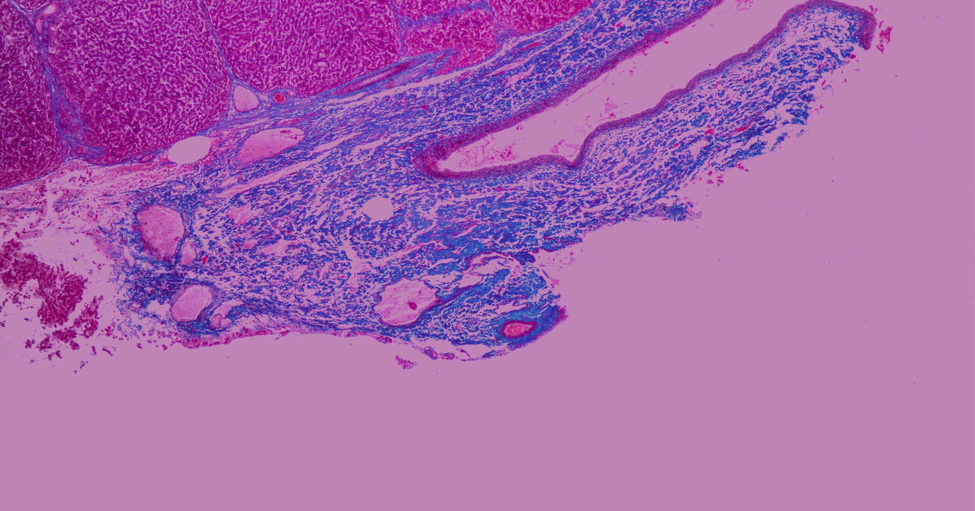 Hepatocellular Carcinoma 