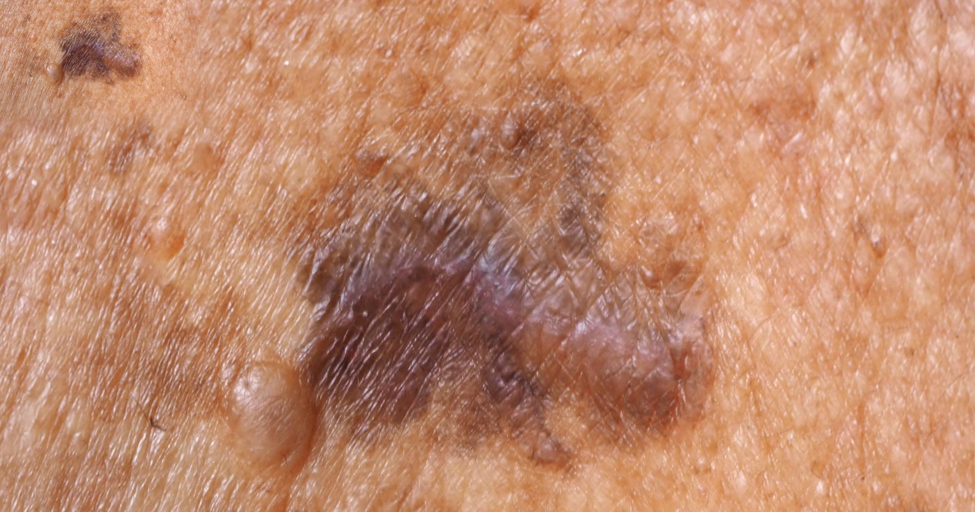 image of skin cancer