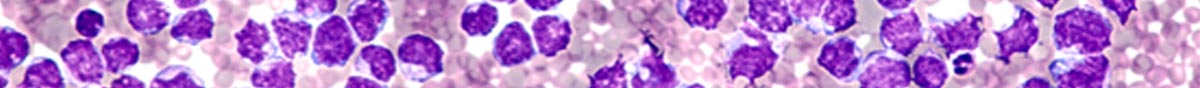 an image of mantle cell lymphoma at the cellular level depicted in varying shades of purple