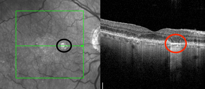 An infra-red image showing a small round area of geographic atrophy nasal to fovea (black circle). Right: A B-scan image of the same eye showing loss of retinal pigment epithelium and photoreceptors nasal to fovea corresponding to the area of geographic atrophy (red circle).