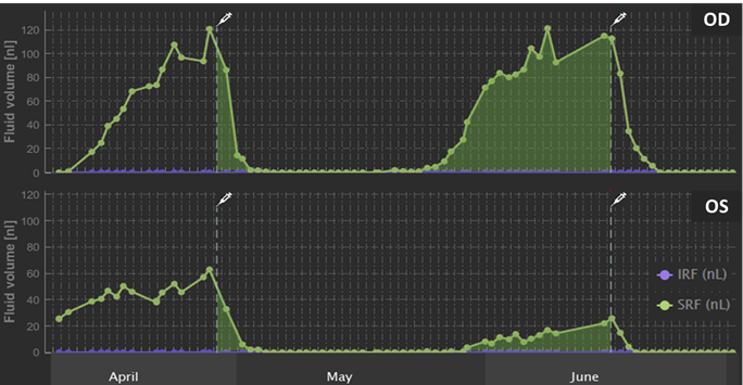 Intra- and sub-retinal fluid (IRF, SRF) volume trajectories