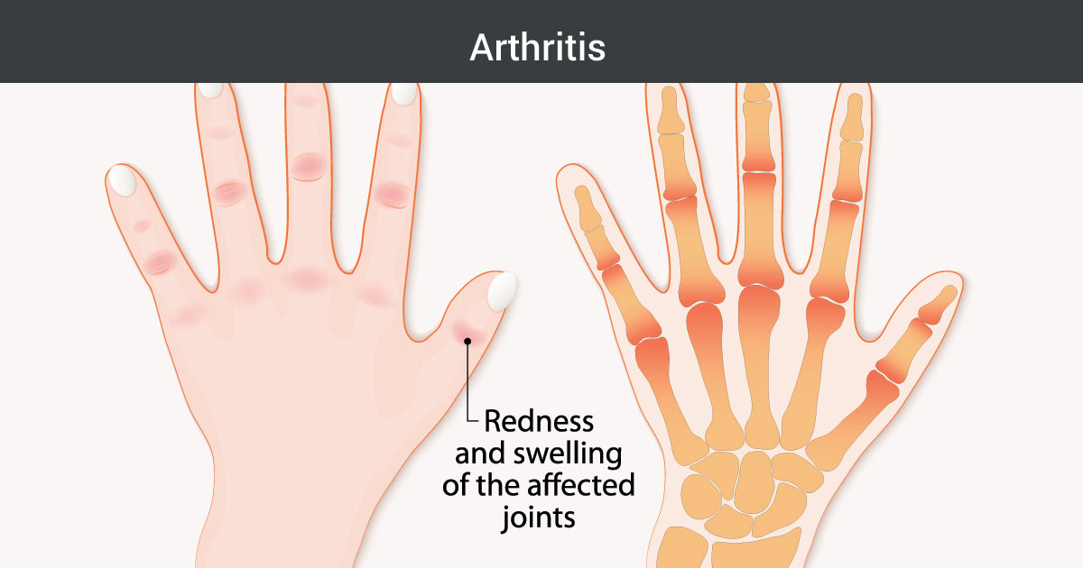 Photo of hands with arthritis