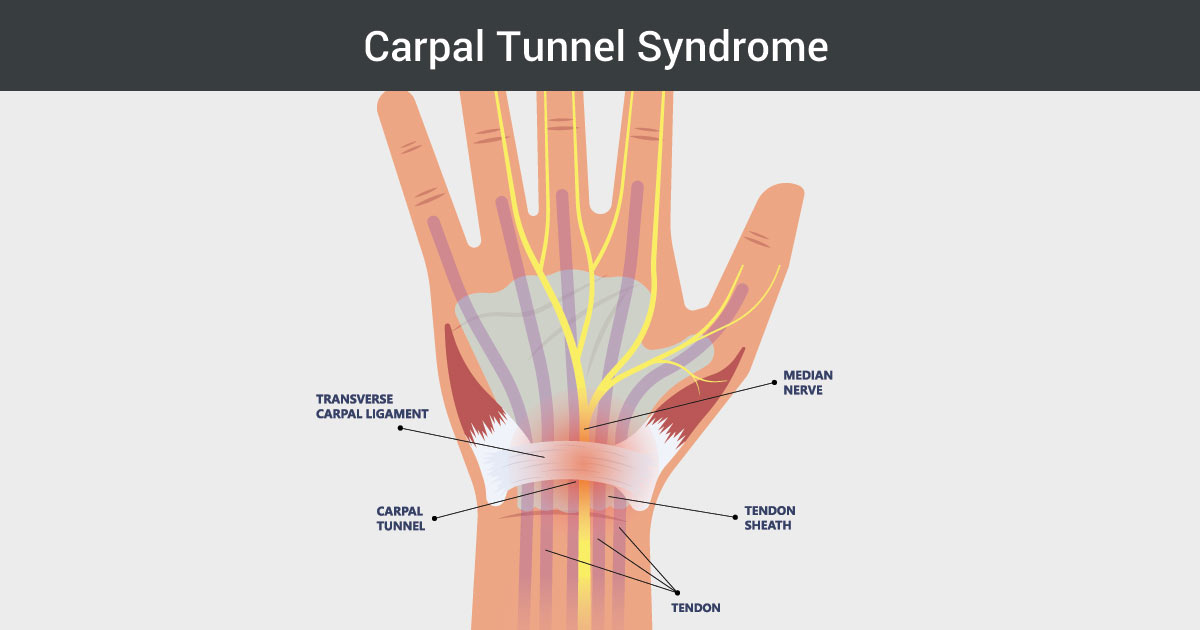 Photo of hand, wrist with carpal tunnel