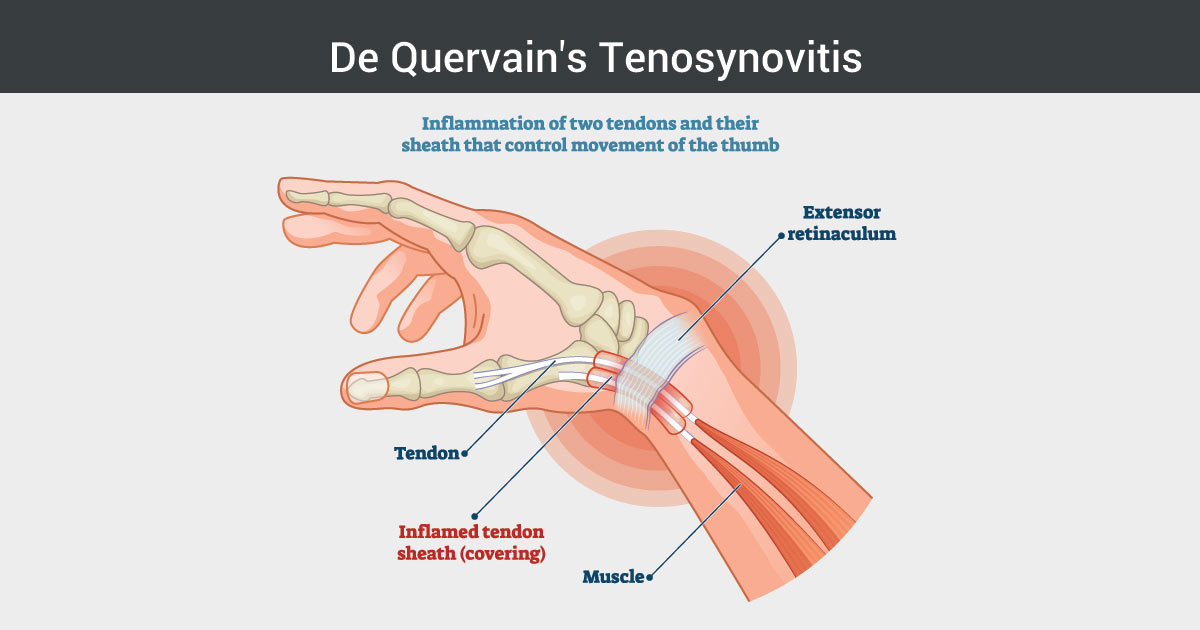 Photo of hand with De Quervain's Tenosynovitis