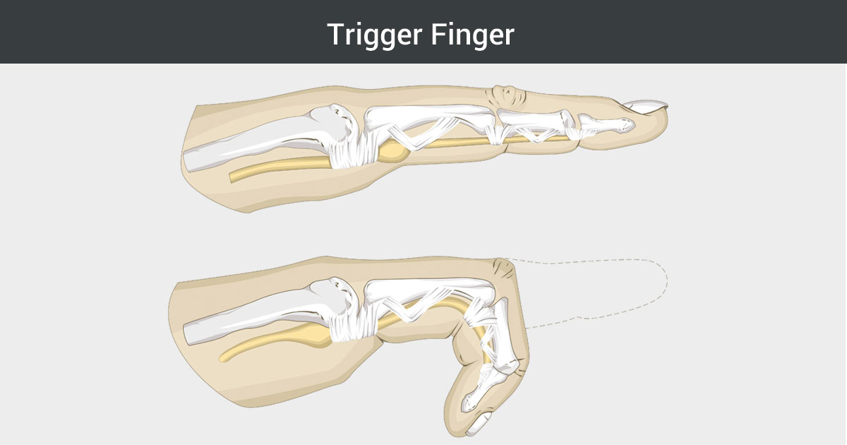 Photo of trigger finger