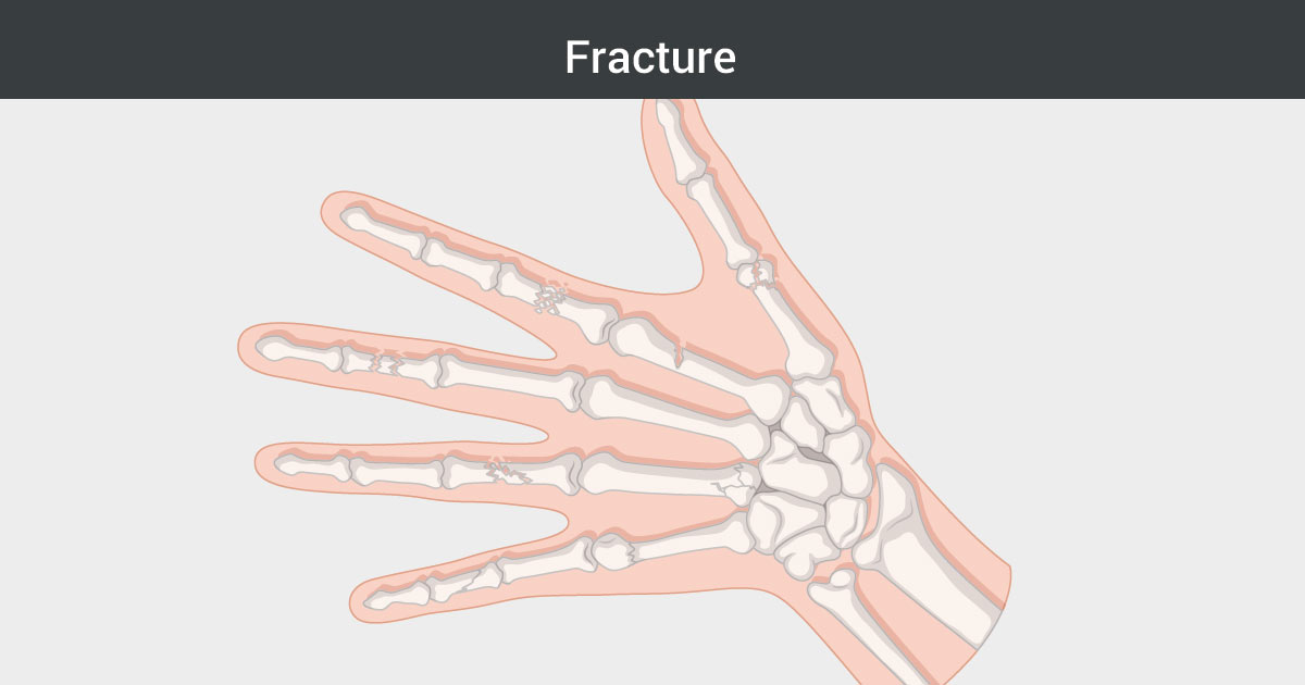 Photo of hand with fracture