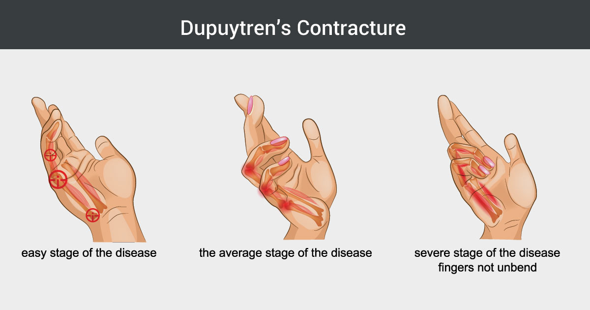 Photo of hand with dupuytren's contracture