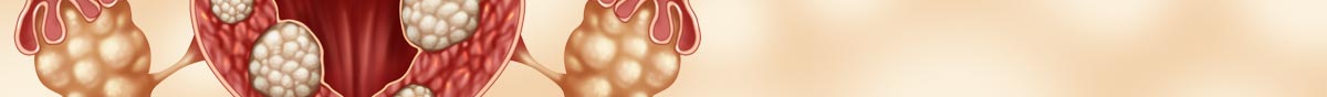 Uterine fibroids collection banner