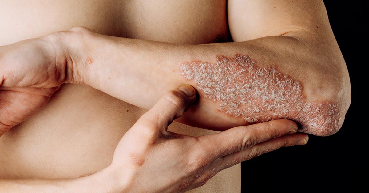 an image of a white skinned person holding their left arm at a right angle across their body displaying scaly red skin of psoriasis on their elbow and forearm against a black background.