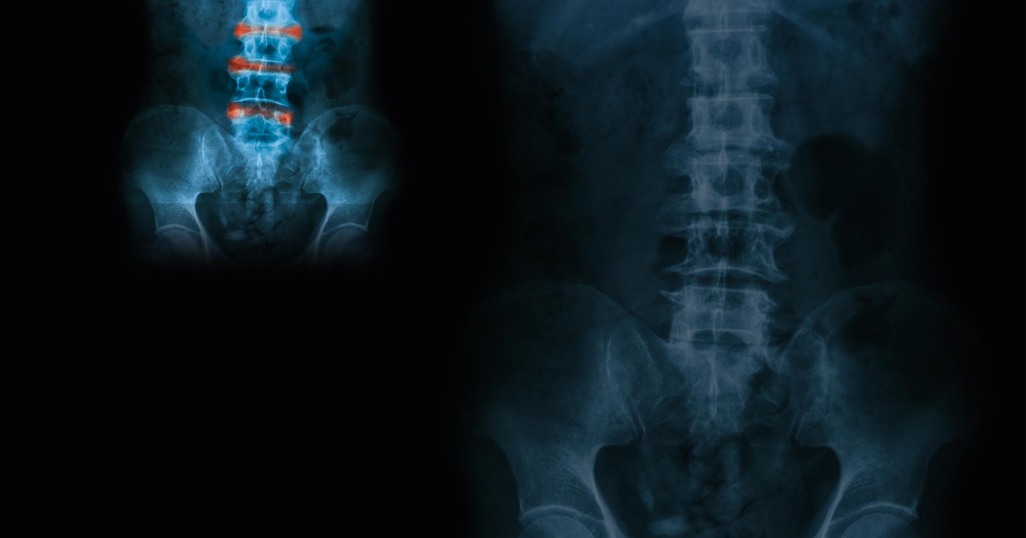 Ankylosing Spondylitis 