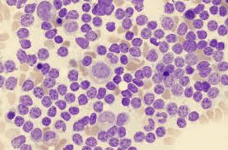 Leukemia