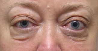 Thyroid Eye Disease: Addressing the Need for Early Intervention and Comanagement