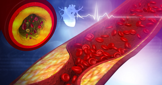 Integrating Novel Therapies in the Management of Homozygous Familial Hypercholesterolemia