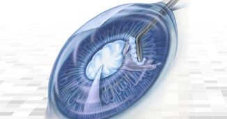 In Case You Missed: Advances in Cataract and Refractive Surgery