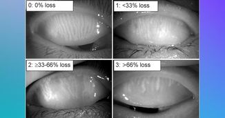 Eyeing the Options for Treating Meibomian Gland Dysfunction and Dry Eye Disease