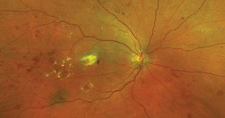 Diabetic Macular Edema: Employing Inflammatory Markers to Predict Improved Visual Outcomes