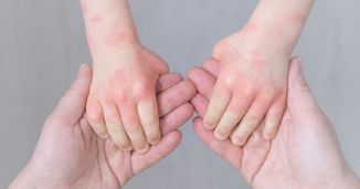 Pediatric Atopic Dermatitis: Clinical Scenarios