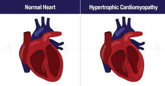 Hypertrophic Cardiomyopathy: Unmasking Disparities and Forging a Path to Equitable Care