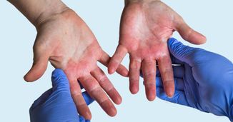 Mastering Hand and Foot Atopic Dermatitis: From Immunology to Innovative Treatments