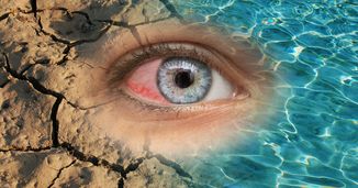 Evaporative Dry Eye: Breaking the Drought in Diagnosis and Treatment