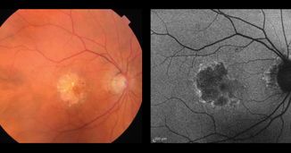 Geographic Atrophy Secondary to Age-Related Macular Degeneration