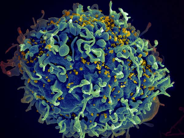 HIV infecting a human immune cell