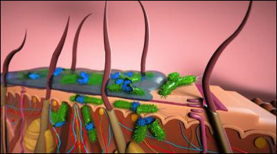 Skin layers with infection