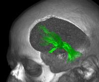 Median forbrain bundle